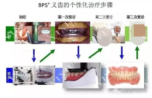 bps吸附性义齿治疗过程 