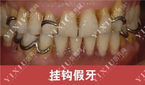 挂钩假牙示意图