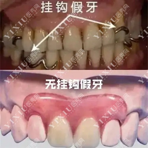 挂钩假牙和无挂钩假牙示意图