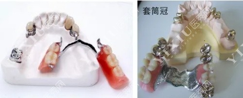无挂钩假牙示意图