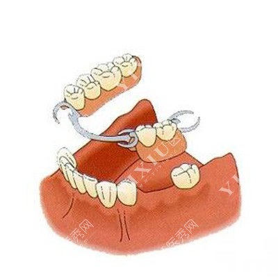 活动义齿修复改善治疗
