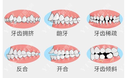 牙齿矫正示意图