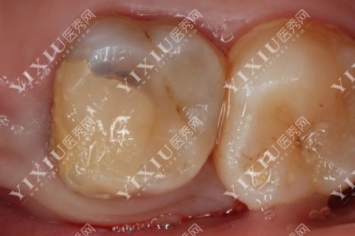 树脂补牙如何防止继发龋在哈尔滨树脂补牙缝防根管治疗