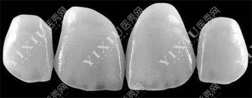 牙齿全瓷贴面