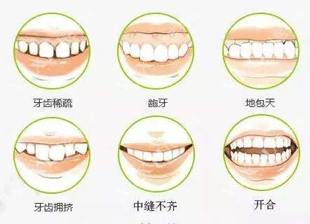 牙齿矫正适应症