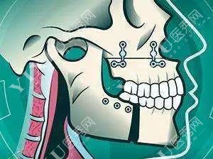 正颌手术漫画图