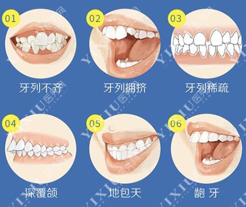 哪些牙齿要做正畸改善治疗