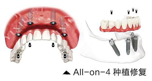 all-no-4种植牙修复示意图
