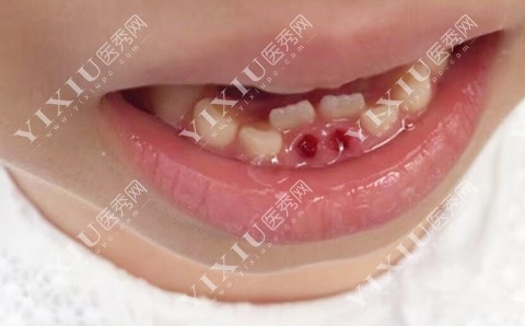 错位的程度比较轻微,就在乳牙附近,那么自行归位的可能性较大儿童换牙