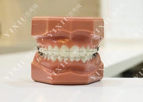 牙齿正畸模型