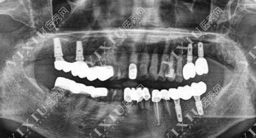 种植牙烤瓷冠术后ct照