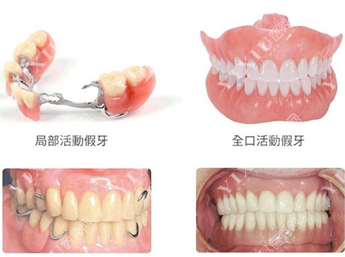 活动义齿修复局部及全口示意图