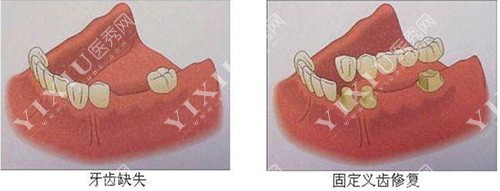牙齿缺失固定修复桥示意图