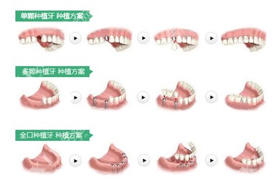 不同颗数种植牙示意图