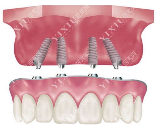 全口种植牙上颌部分