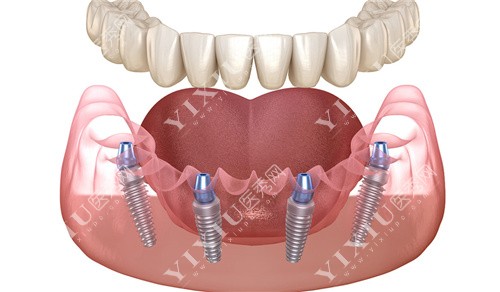 半口种植牙all on 4种植