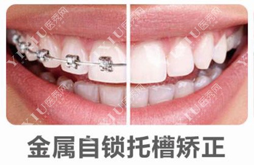 金属自锁托槽矫正示意图