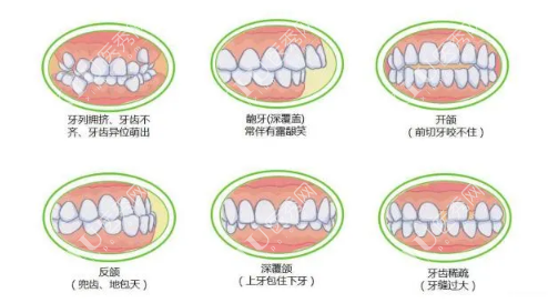 哪些牙齿要做矫正改善