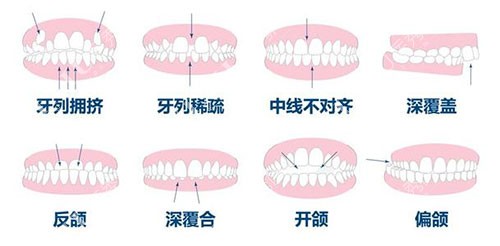 正畸的不同适应症