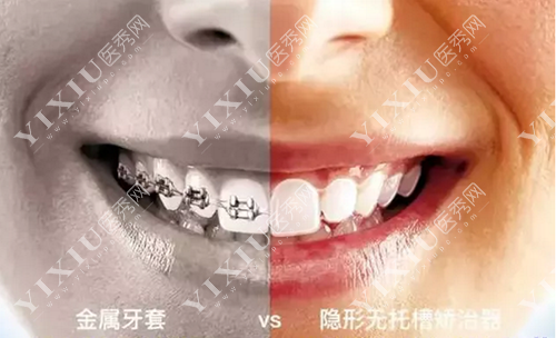 牙齿矫正图示
