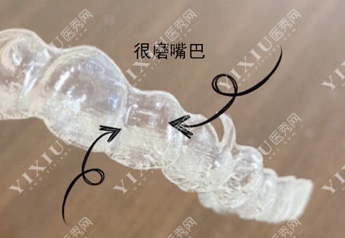 隐适美矫正器附件凸起部位有点磨嘴