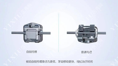 自锁托槽和普通托槽区别