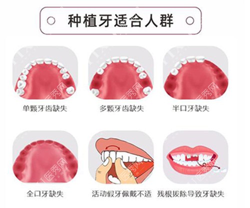 哪些牙齿要做种植改善