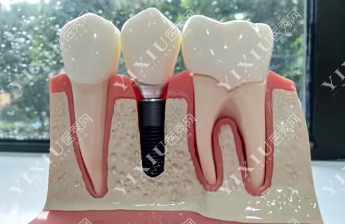 口腔医院种植牙模型展示
