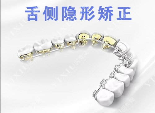舌侧隐形矫正图