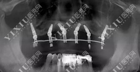 上半口种植牙术后CT图片