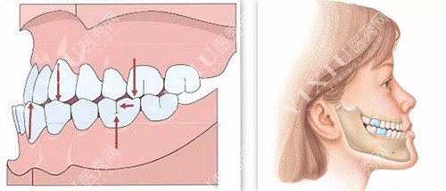 牙齿反颌示意图