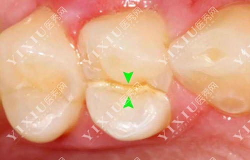 呼和浩特口腔医院收费标准,附整牙种牙补牙所有价格表!(图2) 呼和浩特口腔医院收费标准,附整牙种牙补牙所有价格表!(图2)
