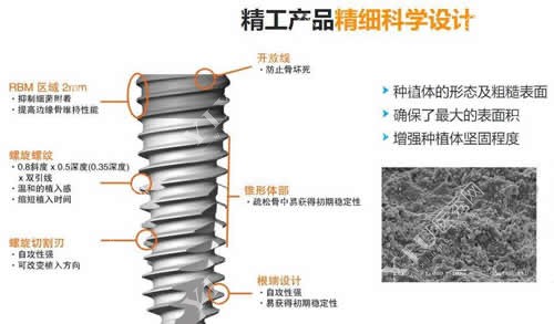 种植牙优势特点分析