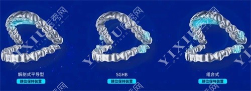 隐形矫正器示意图