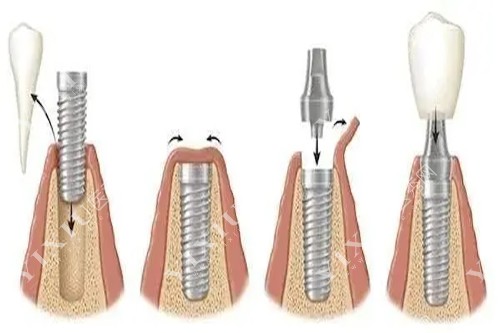 种植牙过程示意图