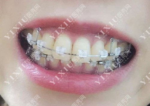 陶瓷半隐形矫正过程图