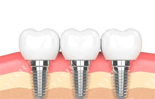 长春传阳口腔种植牙示意图