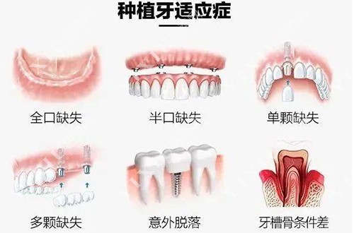 种植牙适应症