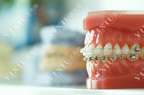 牙齿矫正牙套模型