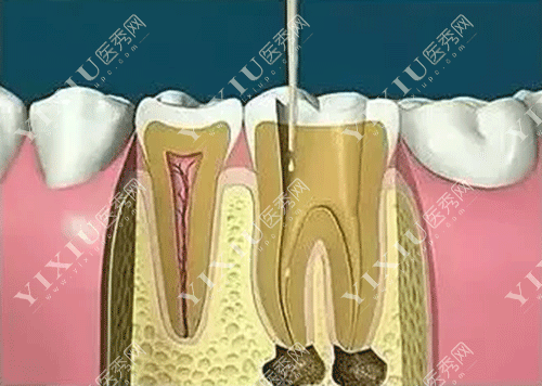 牙齿根管治疗图片
