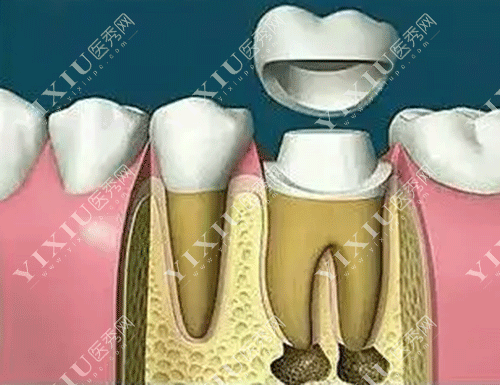 牙齿牙冠的保护作用