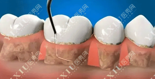 牙齿牙周病治疗图片