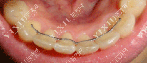 舌侧矫正器的图片