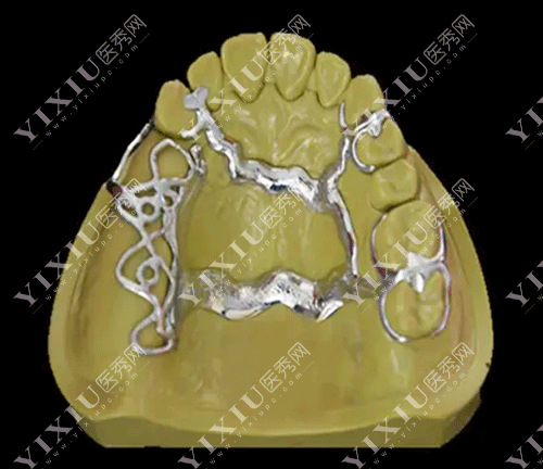 牙齿维他灵支架活动假牙的图片