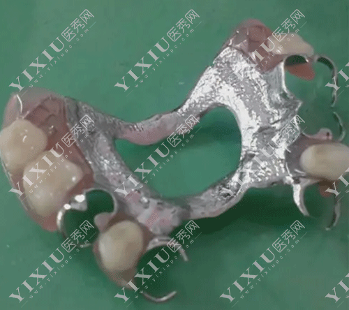 牙齿金属支架活动假牙的图片