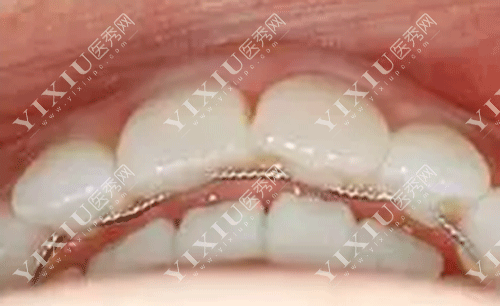 矫正牙齿后戴哪种保持器好 要戴多久?正在矫正牙齿的朋友们看过来(图5) 矫正牙齿后戴哪种保持器好 要戴多久?正在矫正牙齿的朋友们看过来(图5)