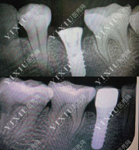 种植牙术后CT图