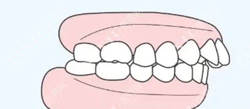 儿童牙齿龅牙的图片