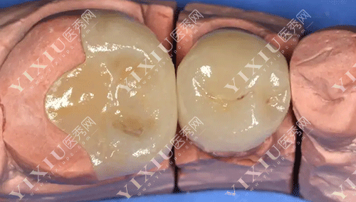 牙齿嵌体修复的图片