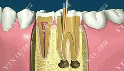 牙齿根管治疗的图片
